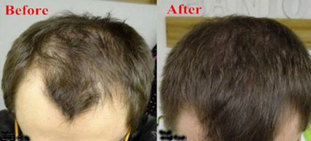 anti-hair loss 1